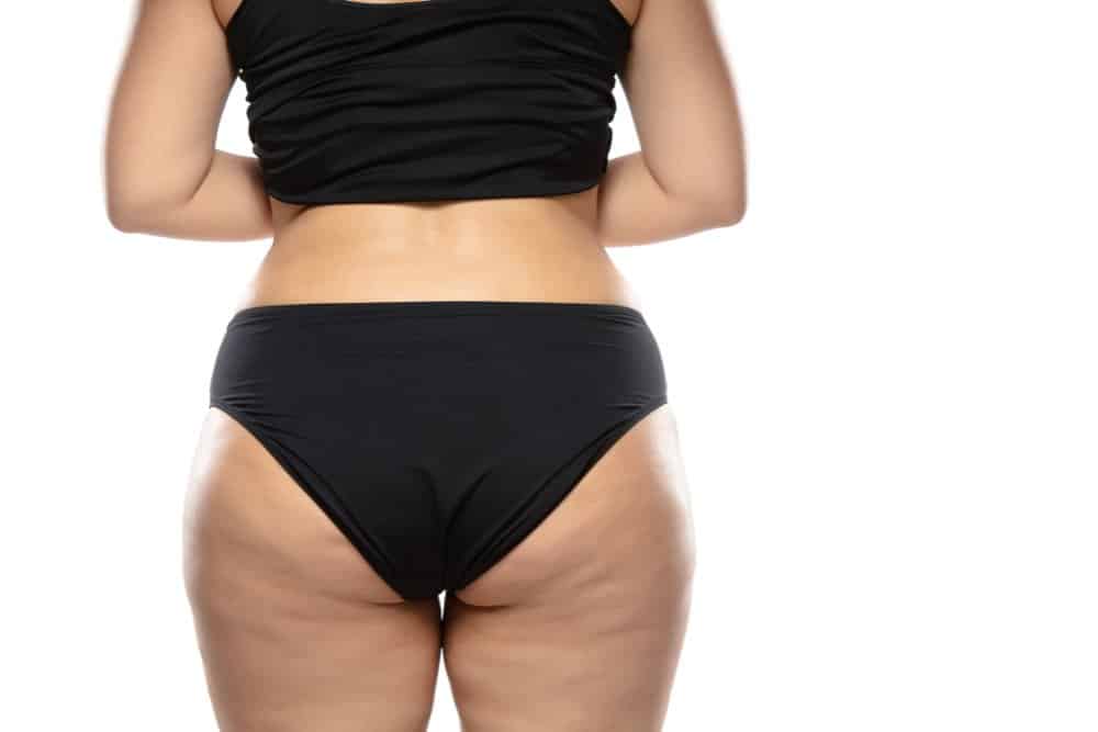 Cellulite et vergetures : Nos conseils pour les éliminer pour cet été